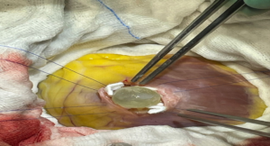 ৫২ বছরের মহিলার হৃদযন্ত্রে কিলবিল করছে পোকা! অসাধ্য সাধন করে মৃত্যুর মুখ থেকে ফেরালেন কলকাতার চিকিৎসকরা!