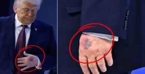 ট্রাম্পের হাতে ‘কালশিটে’ দাগ, US প্রেসিডেন্টের কী হয়েছে? ভাইরাল ছবি
