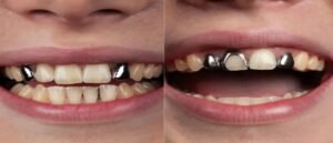 হাসতে গেলেও খরচ! রুপোর দামে আগুন লাগতেই মহার্ঘ্য ‘ডেন্টাল ফিলিং’, দাঁতের চিকিৎসায় পকেটে টান মধ্যবিত্তের!